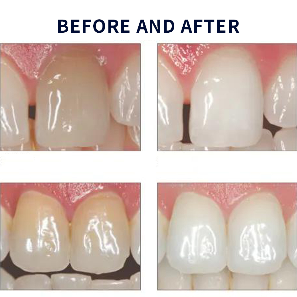 Отбеливающий набор opalution 2 – обзор и цена Teeth Whitening Bleaching Kit