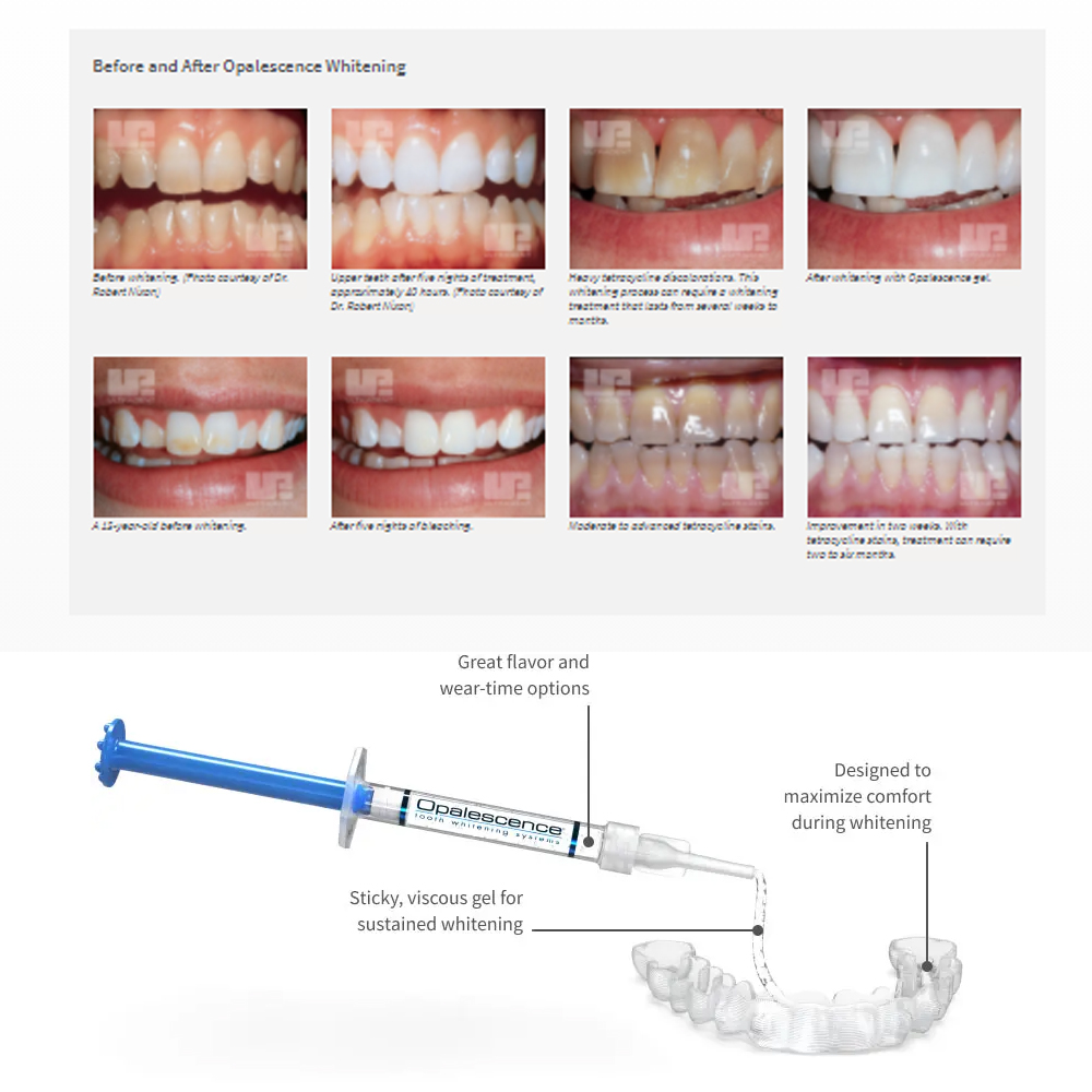 Отбеливающий набор opalution 2 – обзор и цена Teeth Whitening Bleaching Kit