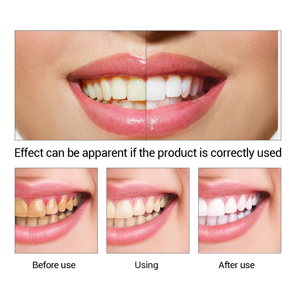 FTEENPLY отбеливание зубов быс – обзор и цена Teeth Whitening Diy