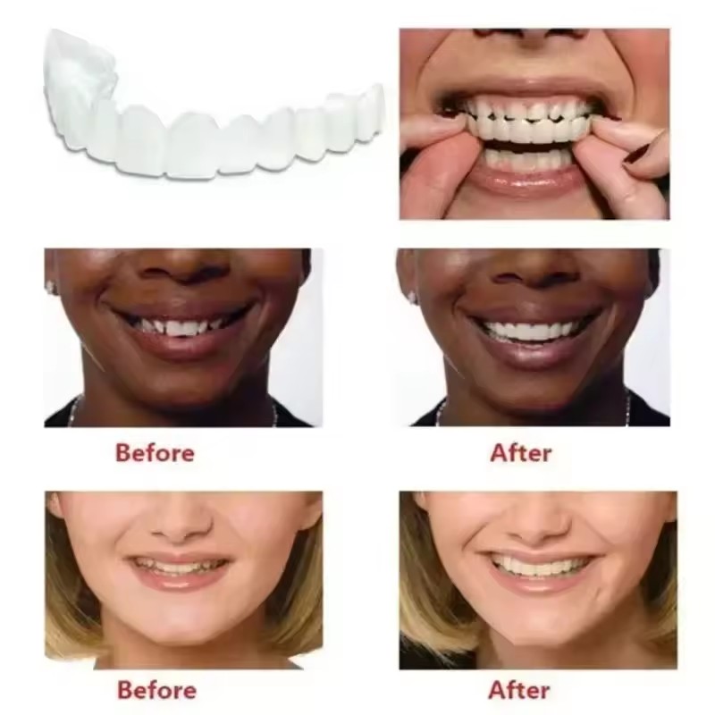 Виниры для отбеливания зубов,  – обзор и цена Teeth Whitening For Braces