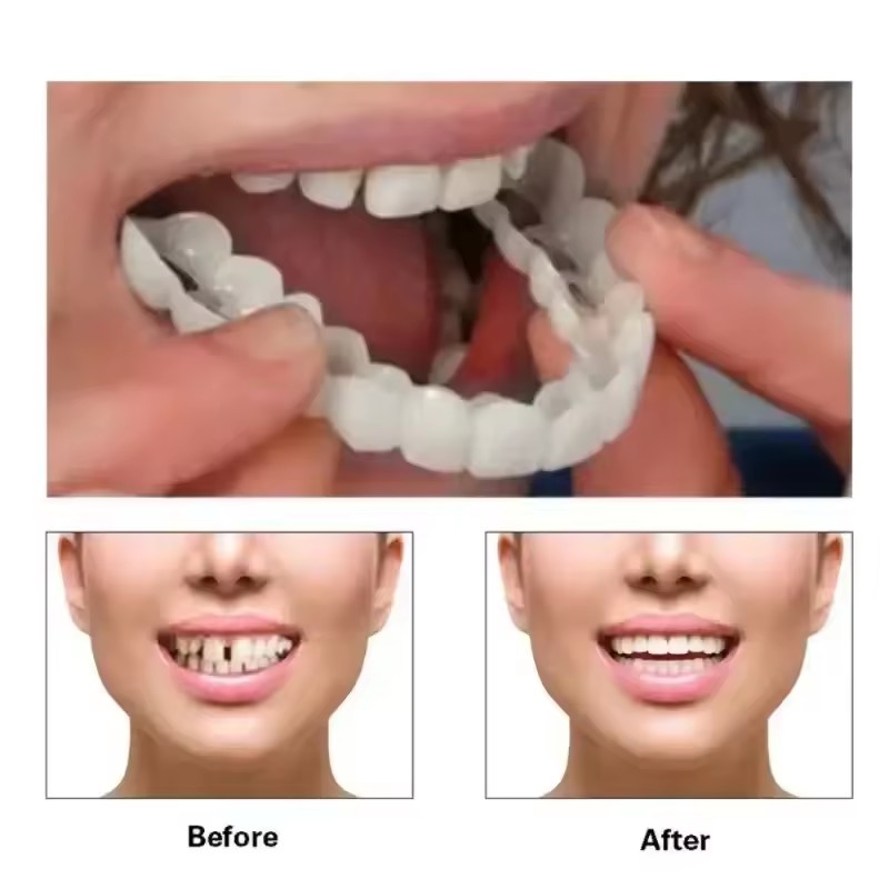 Виниры для отбеливания зубов,  – обзор и цена Teeth Whitening For Braces