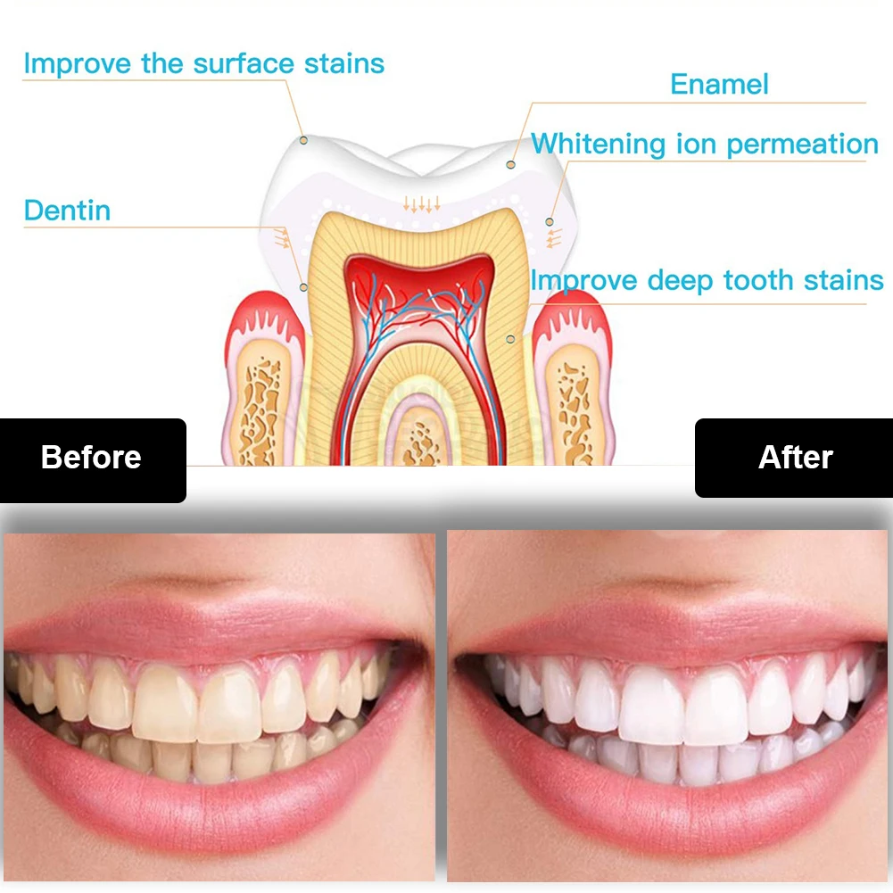 Набор для отбеливания зубов, м – обзор и цена Teeth Whitening Bleaching Kit