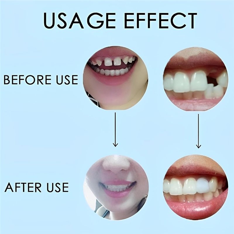 НОВИНКА! ABMK】 2 пары, для вос – обзор и цена Teeth Whitening For Braces
